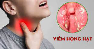 Viêm họng cấp: Nguyên nhân, triệu chứng, chẩn đoán và điều trị