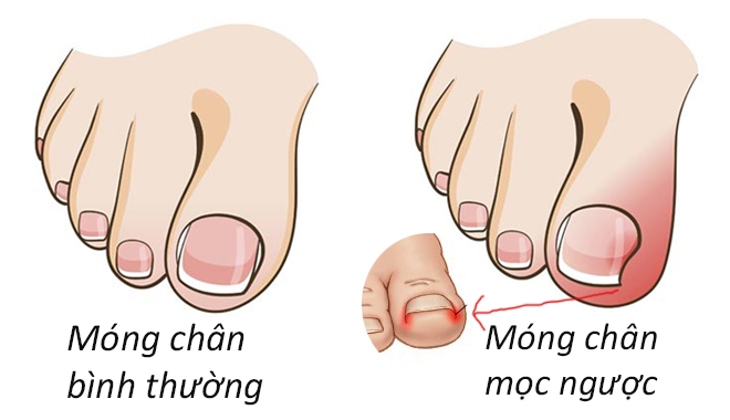 Móng quặp (móng mọc ngược): Nguyên nhân, triệu chứng, chẩn đoán và điều trị