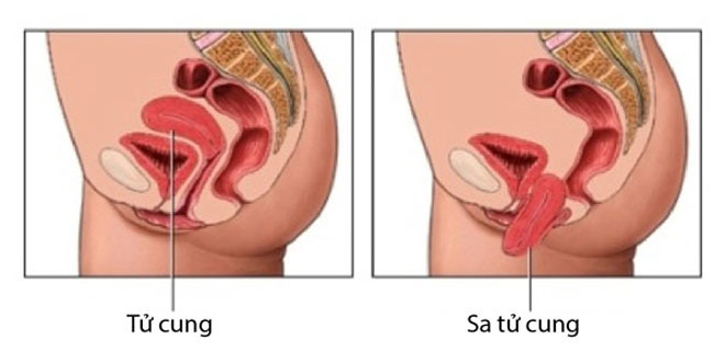 Sa niệu dục – điều trị sa niệu dục