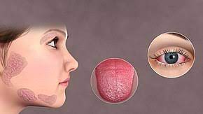 Hội chứng Sjogren: Nguyên nhân, triệu chứng, chẩn đoán và điều trị