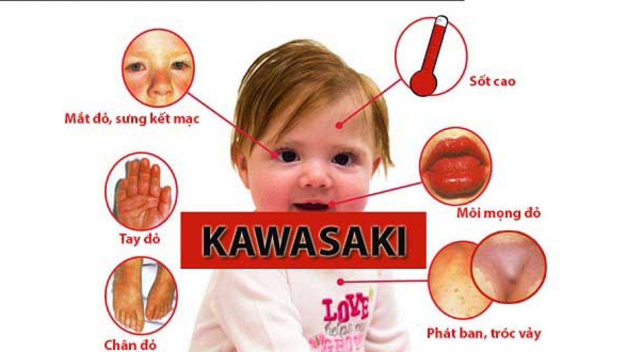 Kawasaki (viêm mạch máu): Nguyên nhân, triệu chứng, chẩn đoán và điều trị