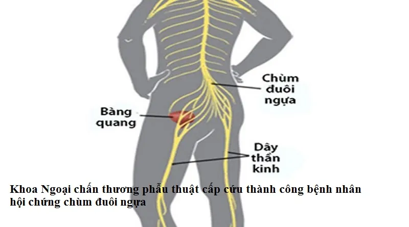 Hội chứng đuôi ngựa: Nguyên nhân, triệu chứng, chẩn đoán và điều trị