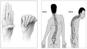 Hội chứng Marfan: Nguyên nhân, triệu chứng, chẩn đoán và điều trị