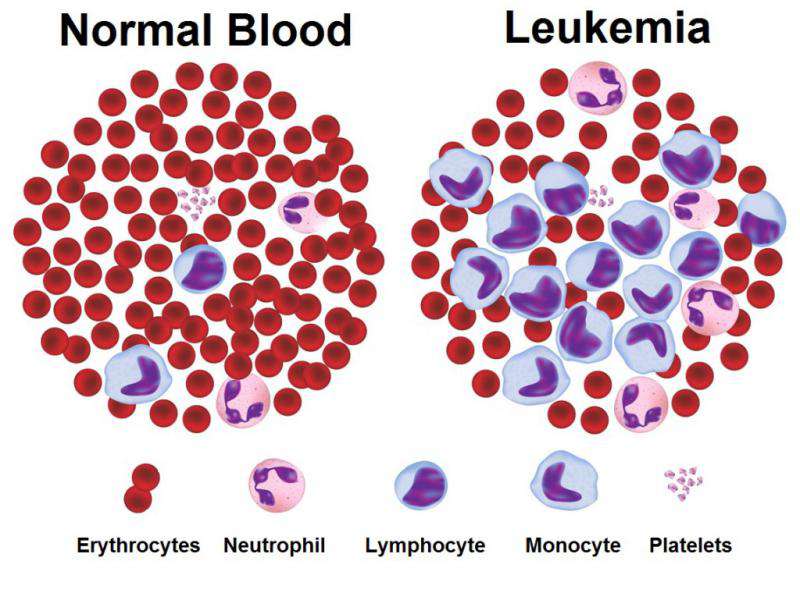 Leukemia kinh dòng bạch cầu hạt (CML): Nguyên nhân, triệu chứng, chẩn đoán và điều trị