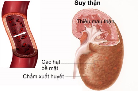 Suy thận: Nguyên nhân, triệu chứng, chẩn đoán và điều trị