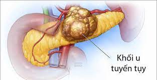 Ung thư tuyến tụy: Nguyên nhân, triệu chứng, chẩn đoán và điều trị