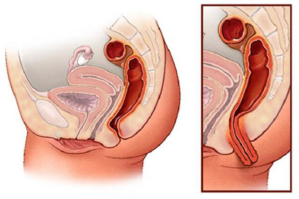 Sa sinh dục: Nguyên nhân, triệu chứng, chẩn đoán và điều trị