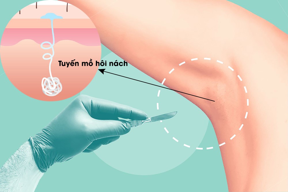 Hôi nách: Nguyên nhân, triệu chứng, chẩn đoán và điều trị