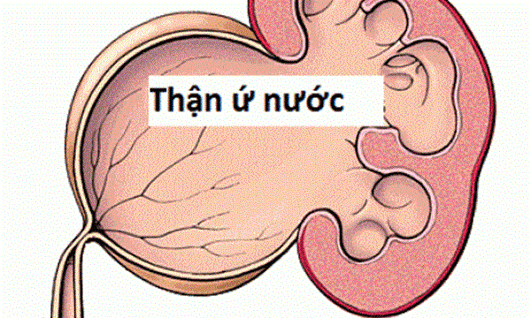 Thận ứ nước: Nguyên nhân, triệu chứng, chẩn đoán và điều trị