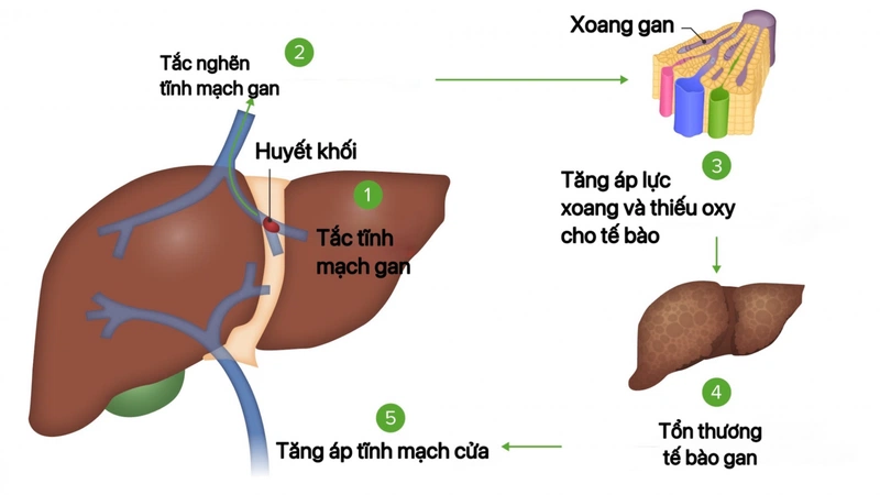 Hội chứng Budd-Chiari: Nguyên nhân, triệu chứng, chẩn đoán và điều trị