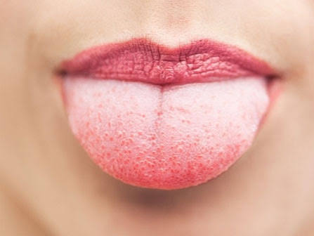 Lưỡi hằn dấu răng cảnh báo điều gì theo y học cổ truyền?