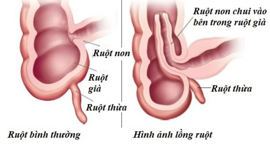 Lồng ruột: Nguyên nhân, triệu chứng, chẩn đoán và điều trị