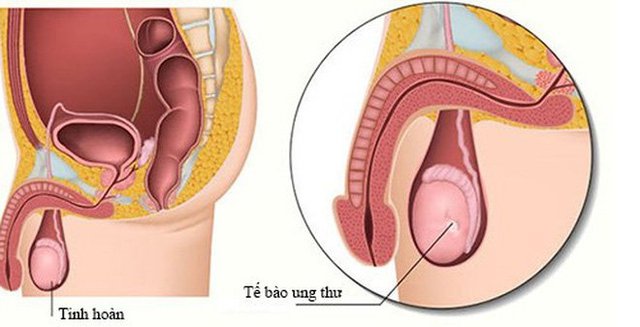 5 dấu hiệu cảnh báo ung thư tinh hoàn