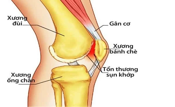 Hội chứng móng và xương bánh chè: Nguyên nhân, triệu chứng, chẩn đoán và điều trị