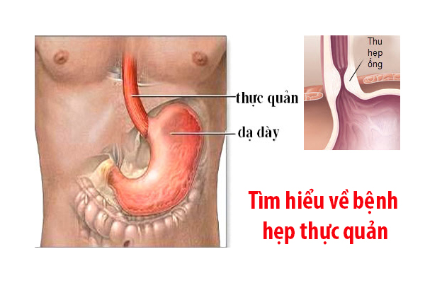 Hẹp thực quản: Nguyên nhân, triệu chứng, chẩn đoán và điều trị