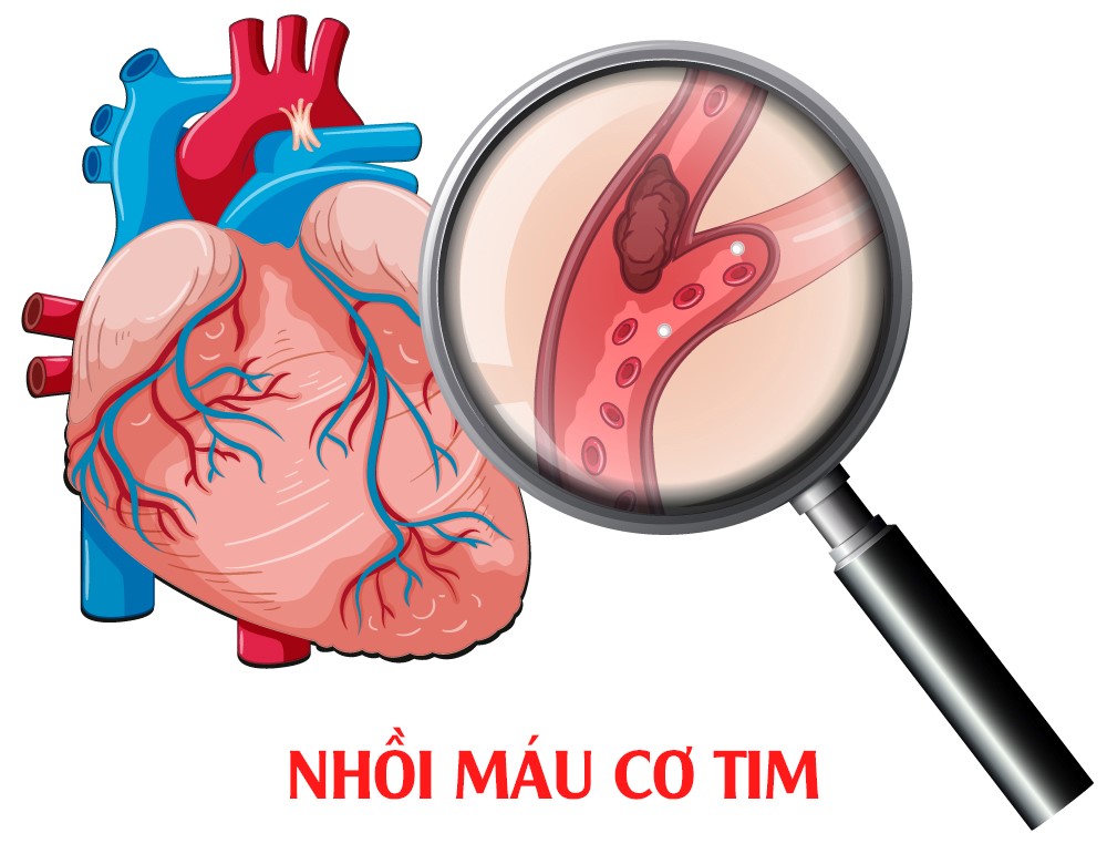 Nhồi máu cơ tim cấp: Nguyên nhân, triệu chứng, chẩn đoán và điều trị