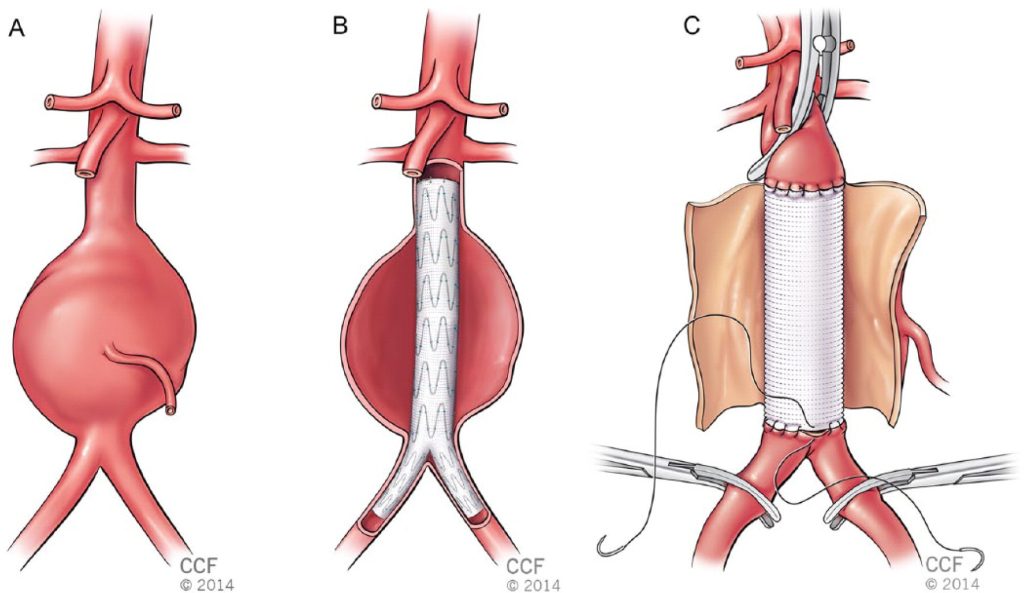 Lóc tách động mạch chủ: Nguyên nhân, triệu chứng, chẩn đoán và điều trị