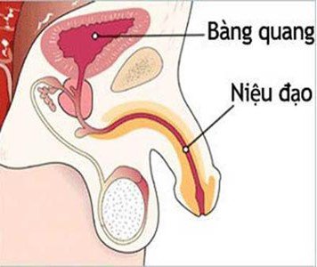 Hẹp niệu đạo có thể gây vô sinh