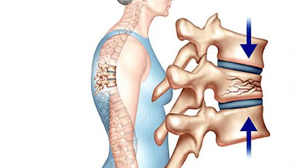 Cách khắc phục loãng xương do dùng corticoid trị viêm loét đại tràng