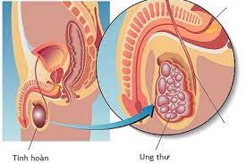 Ung thư tinh hoàn: Nguyên nhân, triệu chứng, chẩn đoán và điều trị