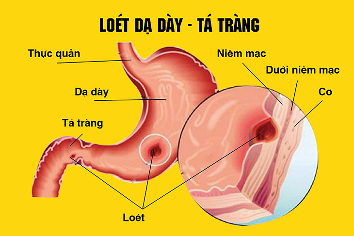 Loét hành tá tràng: Nguyên nhân, triệu chứng, chẩn đoán và điều trị