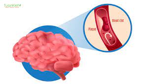 Bệnh sa sút trí tuệ (Dementia). Nguyên nhân, triệu chứng, chẩn đoán và điều trị