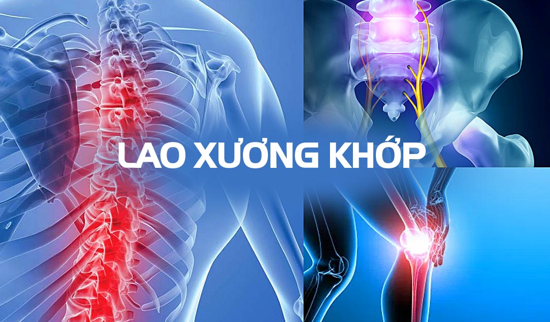 Lao cơ xương: Nguyên nhân, triệu chứng, chẩn đoán và điều trị