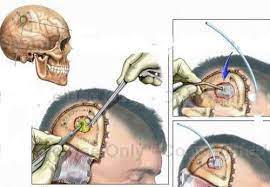 Áp xe não do amip. Nguyên nhân, triệu chứng, chẩn đoán và điều trị