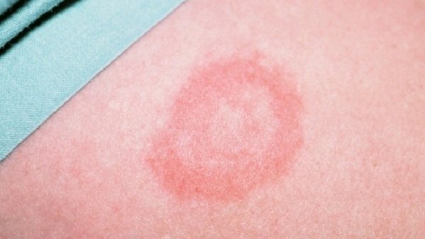 Lyme: Nguyên nhân, triệu chứng, chẩn đoán và điều trị