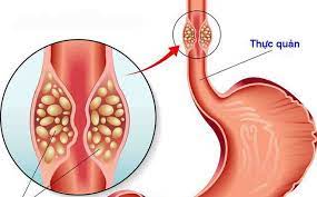 Ung thư thực quản: Nguyên nhân, triệu chứng, chẩn đoán và điều trị