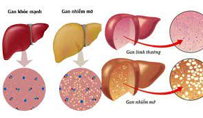 Gan nhiễm mỡ. Nguyên nhân, triệu chứng, chẩn đoán và điều trị