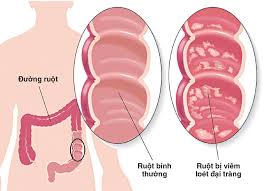 Viêm ruột do virus: Nguyên nhân, triệu chứng, chẩn đoán và điều trị