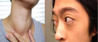 Basedow. Nguyên nhân, triệu chứng, chẩn đoán và điều trị