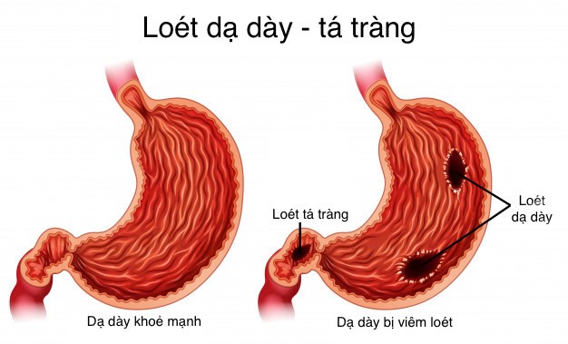 Loét dạ dày tá tràng: Nguyên nhân, triệu chứng, chẩn đoán và điều trị