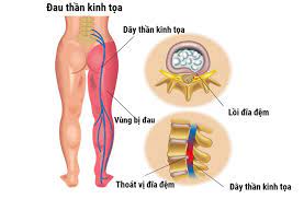 Đau thần kinh tọa. Nguyên nhân, triệu chứng, chẩn đoán và điều trị