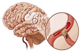 Dị dạng mạch não. Nguyên nhân, triệu chứng, chẩn đoán và điều trị