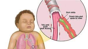 Viêm tiểu phế quản ở trẻ sơ sinh - Nguyên nhân và cách phòng tránh