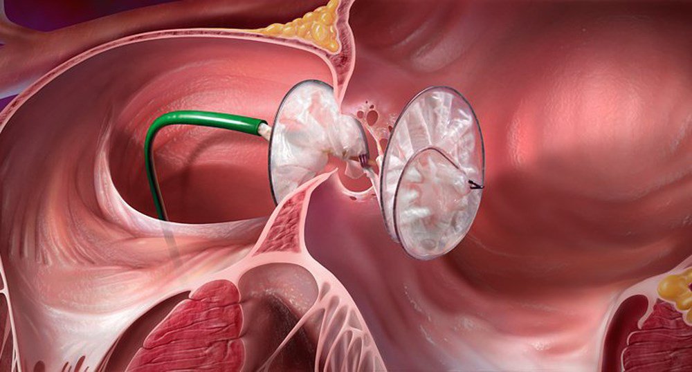 Thông liên nhĩ: Nguyên nhân, triệu chứng, chẩn đoán và điều trị