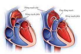 Hẹp van động mạch chủ: Nguyên nhân, triệu chứng, chẩn đoán và điều trị