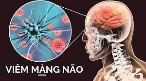 Viêm màng não mủ: Nguyên nhân, triệu chứng, chẩn đoán và điều trị