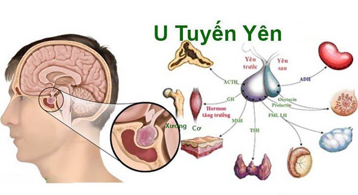 U tuyến yên: Nguyên nhân, triệu chứng, chẩn đoán và điều trị