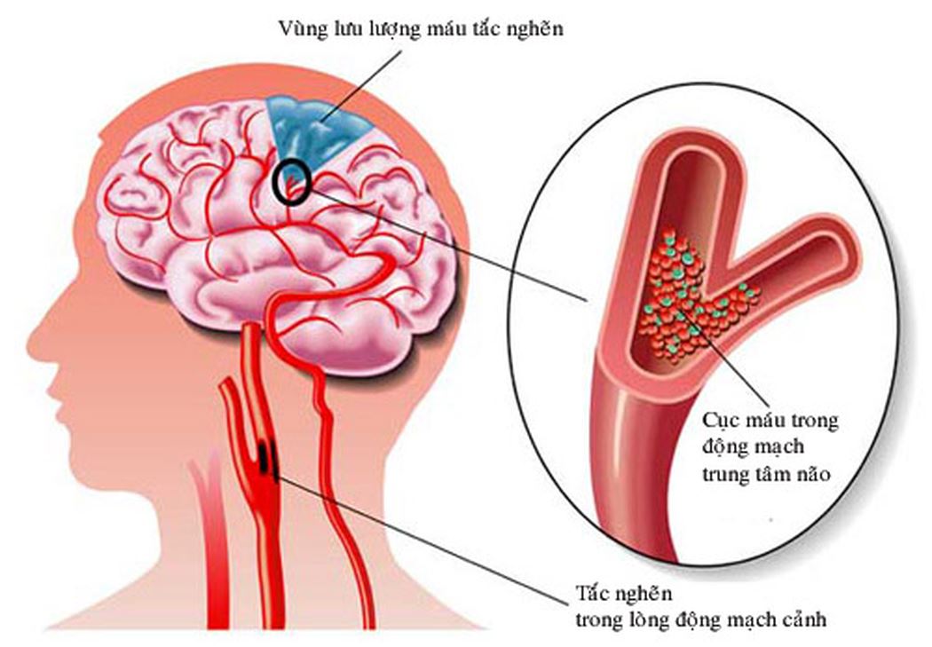 Thiểu năng tuần hoàn não: Nguyên nhân, triệu chứng, chẩn đoán và điều trị