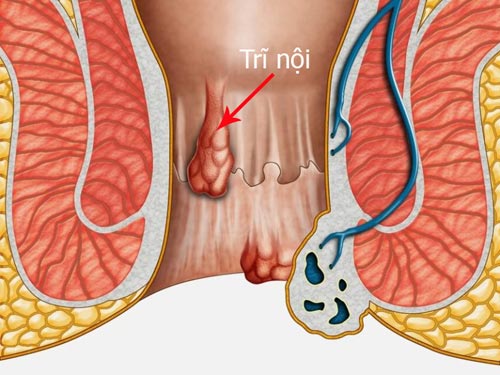 Trĩ nội: Nguyên nhân, triệu chứng, chẩn đoán và điều trị