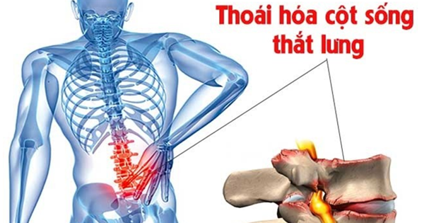 Thoái hóa cột sống thắt lưng: Nguyên nhân, triệu chứng, chẩn đoán và điều trị