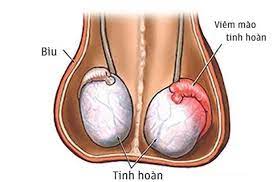 Viêm tinh hoàn: Nguyên nhân, triệu chứng, chẩn đoán và điều trị