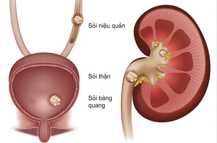 Sỏi niệu quản: Nguyên nhân, triệu chứng, chẩn đoán và điều trị