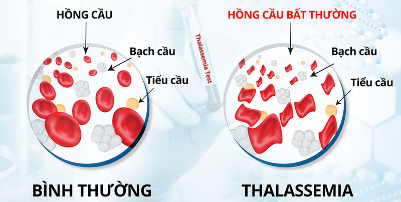 Thalassemia (Tan máu bẩm sinh): Nguyên nhân, triệu chứng, chẩn đoán và điều trị