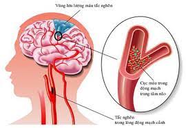 Đột quỵ não. Nguyên nhân, triệu chứng, chẩn đoán và điều trị