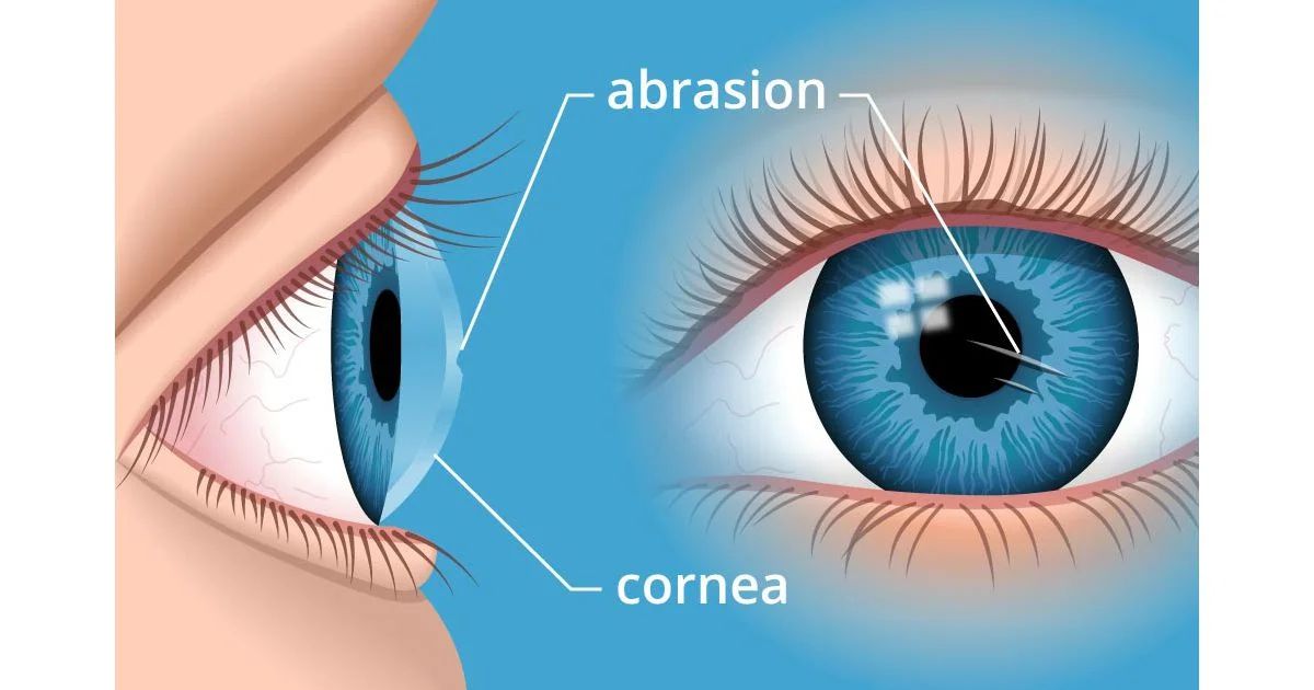 Rách giác mạc: Nguyên nhân, triệu chứng, chẩn đoán và điều trị