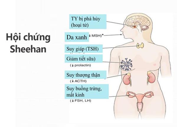 Hội chứng Sheehan: Nguyên nhân, triệu chứng, chẩn đoán và điều trị